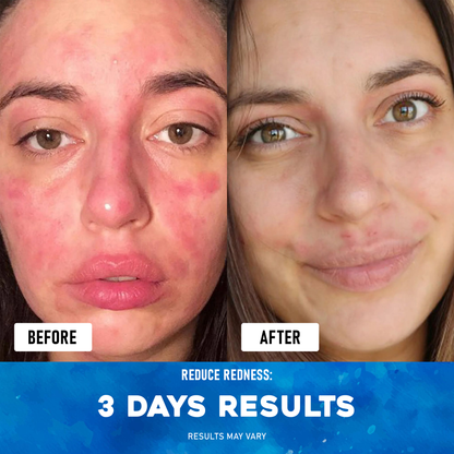 Exnotic™ -The Ocean Healed My Eczema