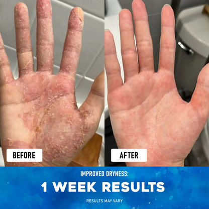 Exnotic™ -The Ocean Healed My Eczema