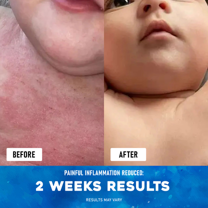 Exnotic™ -The Ocean Healed My Eczema