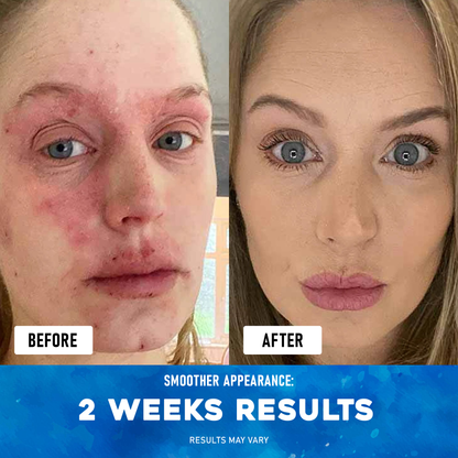 Exnotic™ -The Ocean Healed My Eczema